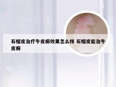 石榴皮治疗牛皮癣效果怎么样 石榴皮能治牛皮癣