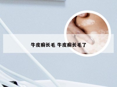 牛皮癣长毛 牛皮癣长毛了