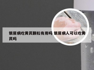 银屑病吃黄芪颗粒有用吗 银屑病人可以吃黄芪吗
