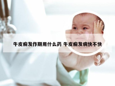 牛皮癣发作期用什么药 牛皮癣发病快不快