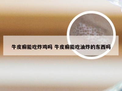 牛皮癣能吃炸鸡吗 牛皮癣能吃油炸的东西吗