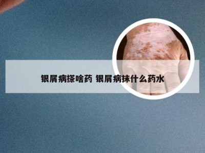 银屑病搽啥药 银屑病抹什么药水