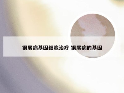 银屑病基因细胞治疗 银屑病的基因