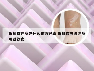 银屑病注意吃什么东西好卖 银屑病应该注意哪些饮食