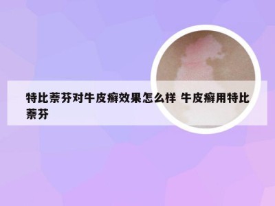 特比萘芬对牛皮癣效果怎么样 牛皮癣用特比萘芬