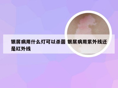 银屑病用什么灯可以杀菌 银屑病用紫外线还是红外线