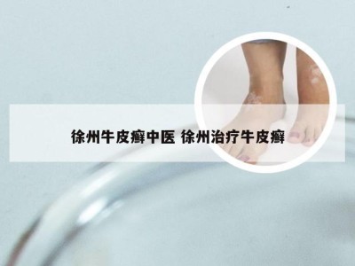徐州牛皮癣中医 徐州治疗牛皮癣