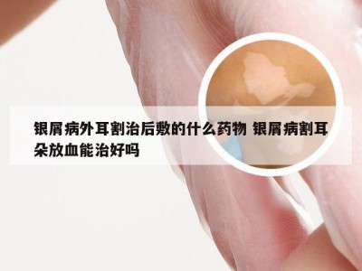 银屑病外耳割治后敷的什么药物 银屑病割耳朵放血能治好吗