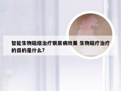 智能生物磁烙治疗银屑病效果 生物磁疗治疗的目的是什么?