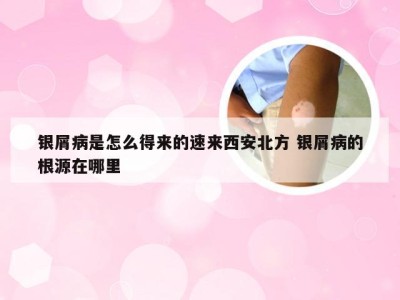 银屑病是怎么得来的速来西安北方 银屑病的根源在哪里