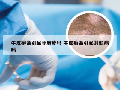 牛皮癣会引起荨麻疹吗 牛皮癣会引起其他病吗