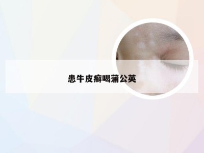 患牛皮癣喝蒲公英
