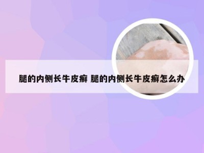 腿的内侧长牛皮癣 腿的内侧长牛皮癣怎么办