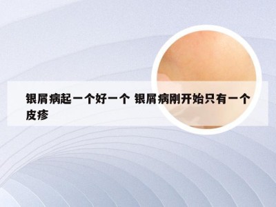 银屑病起一个好一个 银屑病刚开始只有一个皮疹