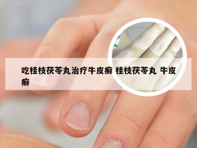 吃桂枝茯苓丸治疗牛皮癣 桂枝茯苓丸 牛皮癣