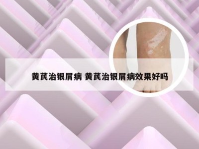 黄芪治银屑病 黄芪治银屑病效果好吗