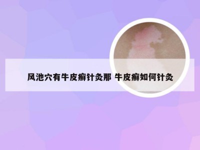 风池穴有牛皮癣针灸那 牛皮癣如何针灸