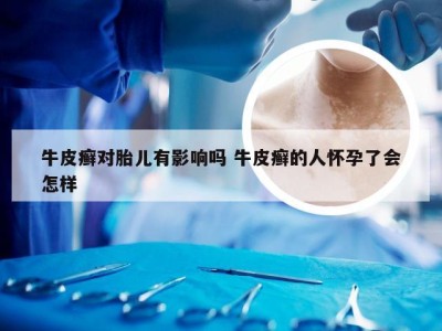 牛皮癣对胎儿有影响吗 牛皮癣的人怀孕了会怎样