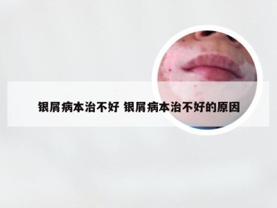 银屑病本治不好 银屑病本治不好的原因