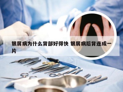银屑病为什么背部好得快 银屑病后背连成一片