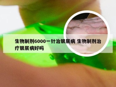 生物制剂6000一针治银屑病 生物制剂治疗银屑病好吗