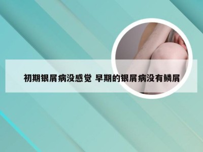 初期银屑病没感觉 早期的银屑病没有鳞屑