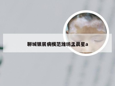 聊城银屑病模范潍坊孟晨星a