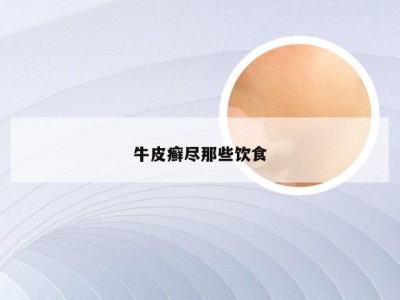 牛皮癣尽那些饮食