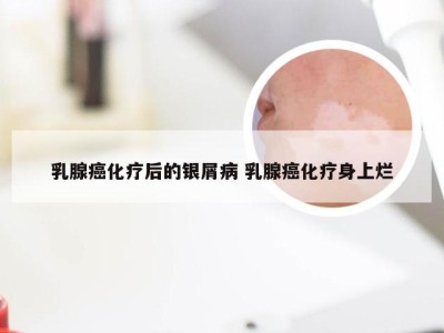 乳腺癌化疗后的银屑病 乳腺癌化疗身上烂