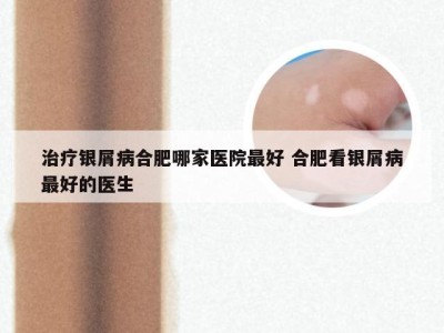 治疗银屑病合肥哪家医院最好 合肥看银屑病最好的医生