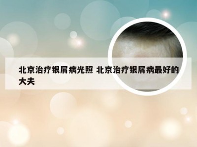 北京治疗银屑病光照 北京治疗银屑病最好的大夫