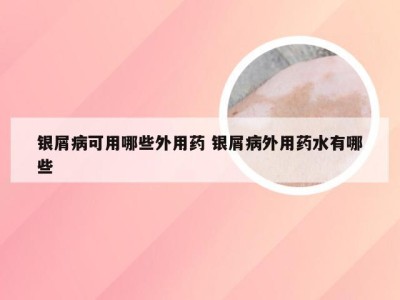 银屑病可用哪些外用药 银屑病外用药水有哪些