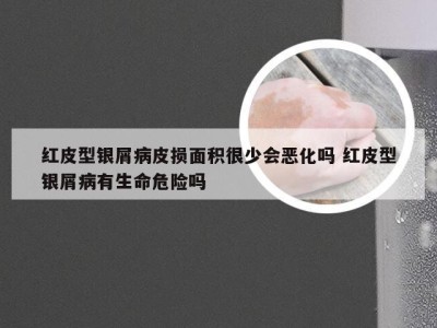 红皮型银屑病皮损面积很少会恶化吗 红皮型银屑病有生命危险吗
