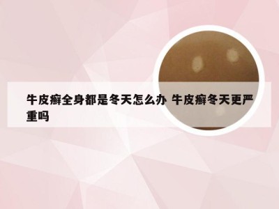 牛皮癣全身都是冬天怎么办 牛皮癣冬天更严重吗