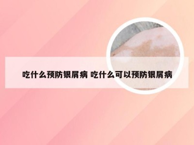 吃什么预防银屑病 吃什么可以预防银屑病