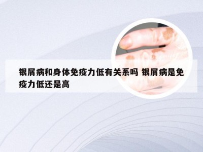 银屑病和身体免疫力低有关系吗 银屑病是免疫力低还是高
