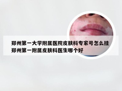 郑州第一大学附属医院皮肤科专家号怎么挂 郑州第一附属皮肤科医生哪个好