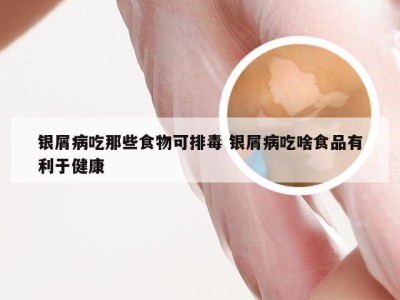 银屑病吃那些食物可排毒 银屑病吃啥食品有利于健康