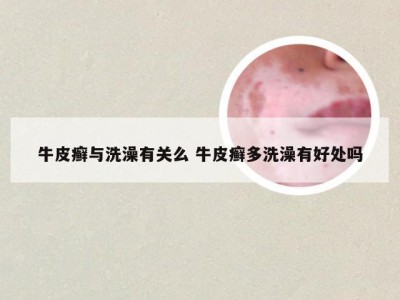 牛皮癣与洗澡有关么 牛皮癣多洗澡有好处吗