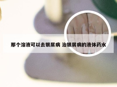 那个溶液可以去银屑病 治银屑病的液体药水