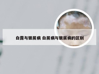 白露与银屑病 白屑病与银屑病的区别