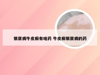 银屑病牛皮癣有啥药 牛皮癣银屑病的药