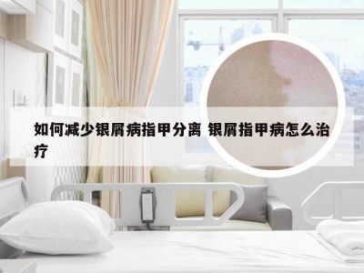 如何减少银屑病指甲分离 银屑指甲病怎么治疗