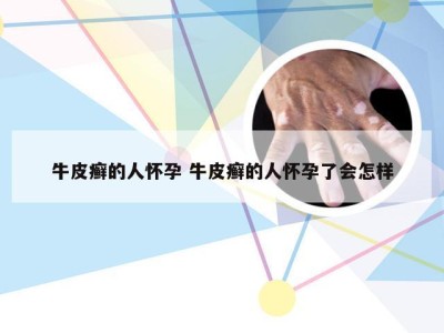 牛皮癣的人怀孕 牛皮癣的人怀孕了会怎样
