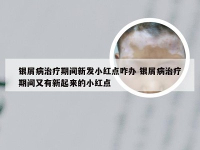 银屑病治疗期间新发小红点咋办 银屑病治疗期间又有新起来的小红点