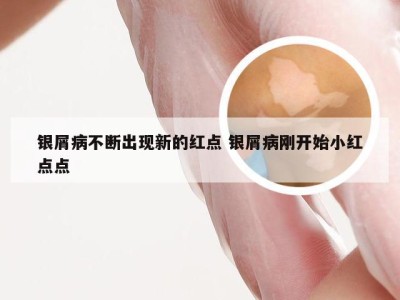 银屑病不断出现新的红点 银屑病刚开始小红点点