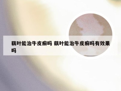 藕叶能治牛皮癣吗 藕叶能治牛皮癣吗有效果吗