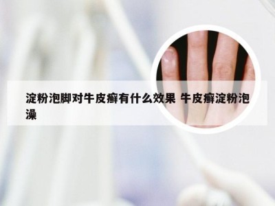 淀粉泡脚对牛皮癣有什么效果 牛皮癣淀粉泡澡