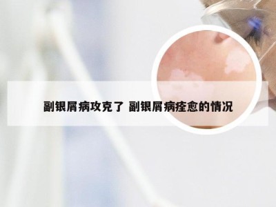 副银屑病攻克了 副银屑病痊愈的情况