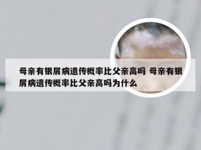 母亲有银屑病遗传概率比父亲高吗 母亲有银屑病遗传概率比父亲高吗为什么